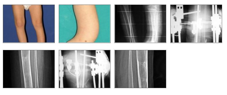 Craniotomy and Craniectomy Coding (CPT)