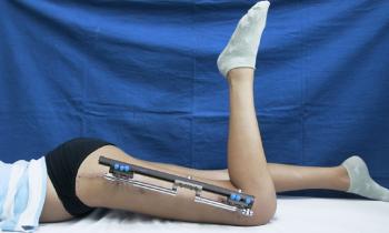How is Lengthening Surgery Performed?
