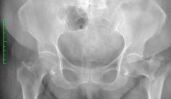 Hip Fracture Treatment for...