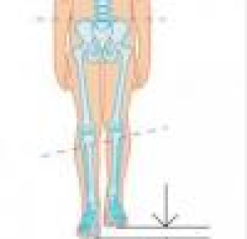 Leg (Limb) Shortness (Phocomely)
