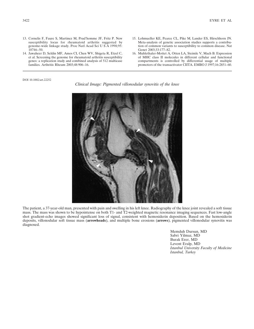 Clinical image: pigmented villonodular synovitis of the knee — ilk sayfa