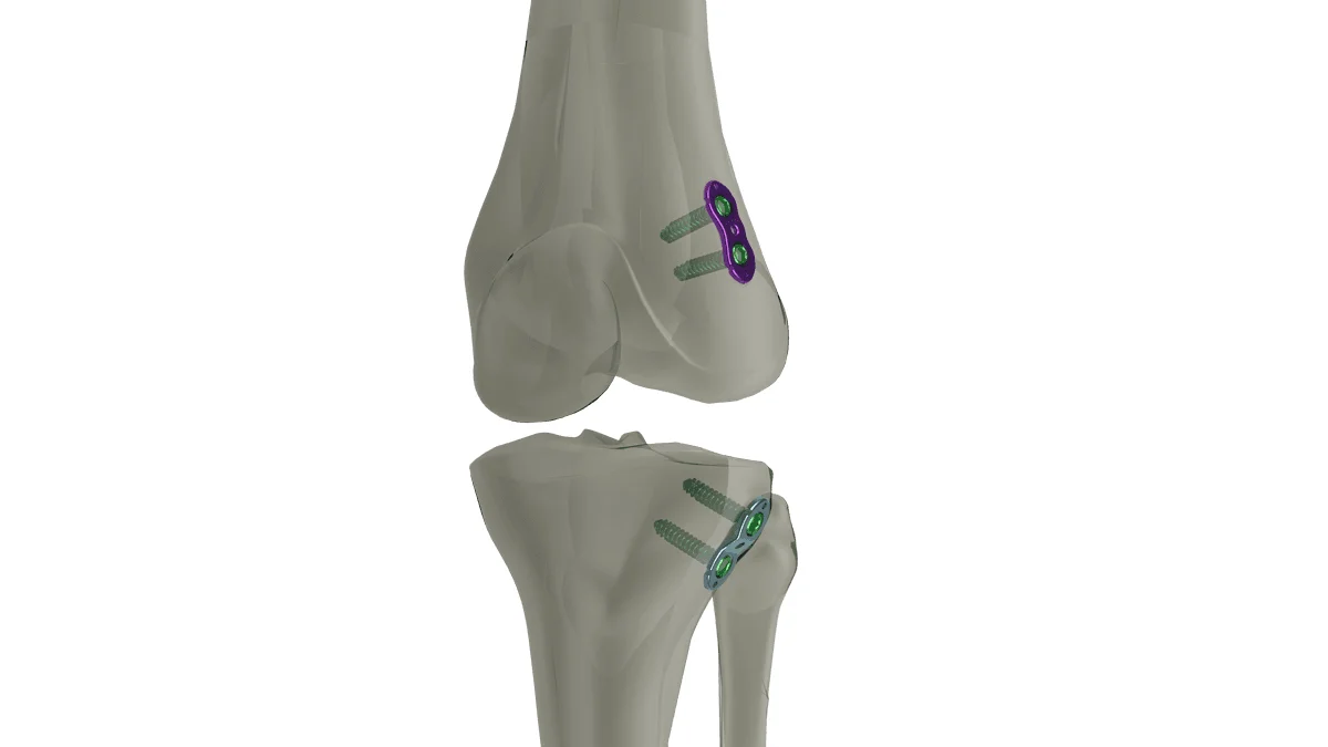 EpiFix büyüme yönlendirme plağının diz eklemi çevresinde femur ve tibia büyüme plaklarına yerleşimi