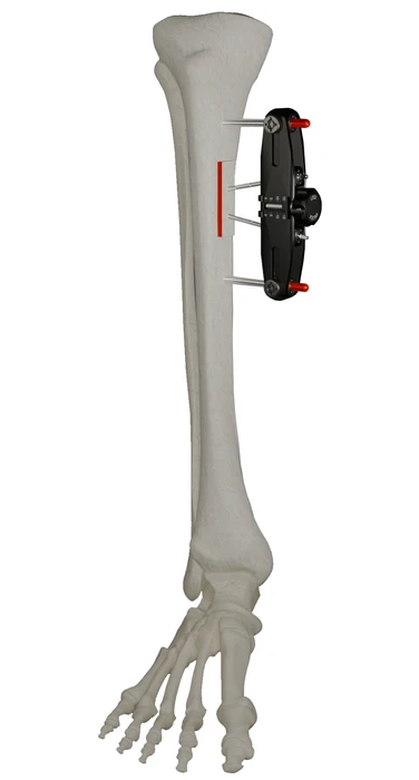 MicroLift sistemi kaval kemiği üzerinde, enine taşınacak kemik parçası kırmızıyla işaretli