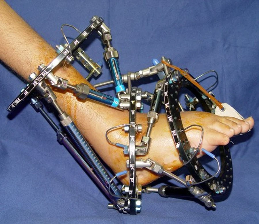 Ayak tipi hexapod çerçevesinin bir hastanın ayak bileğine uygulanmış hâli
