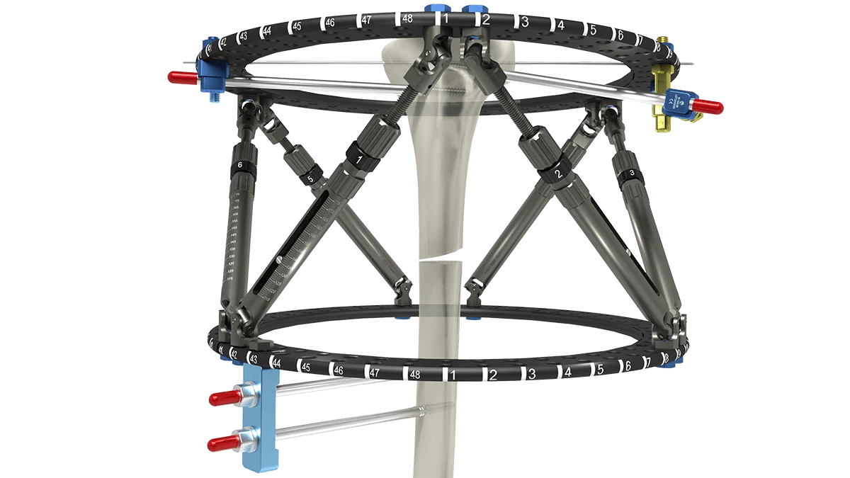 Smart Fixator Hexapod halkaları ve ayarlanabilir strut sistemi