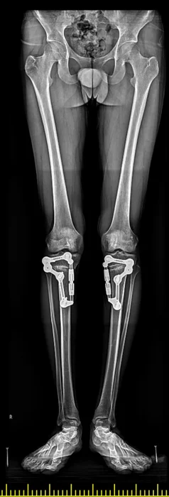 Aynı hastanın iki dizine de UniPlasty uygulandıktan sonraki kontrol röntgeni